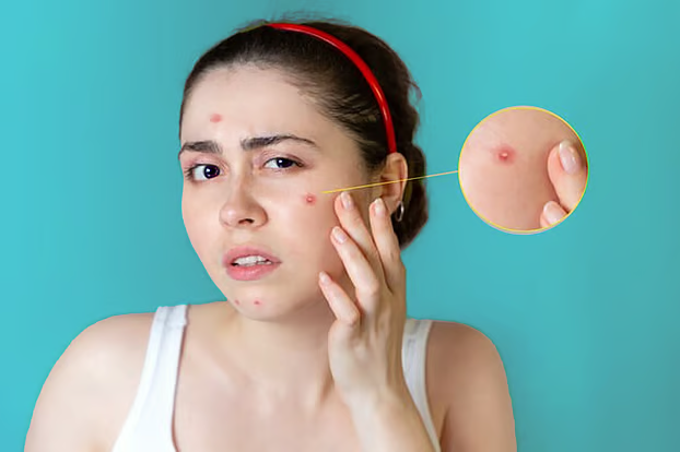 ২৪ ঘণ্টার মধ্যে ব্রণ দূর করার ৭ কার্যকর উপায়